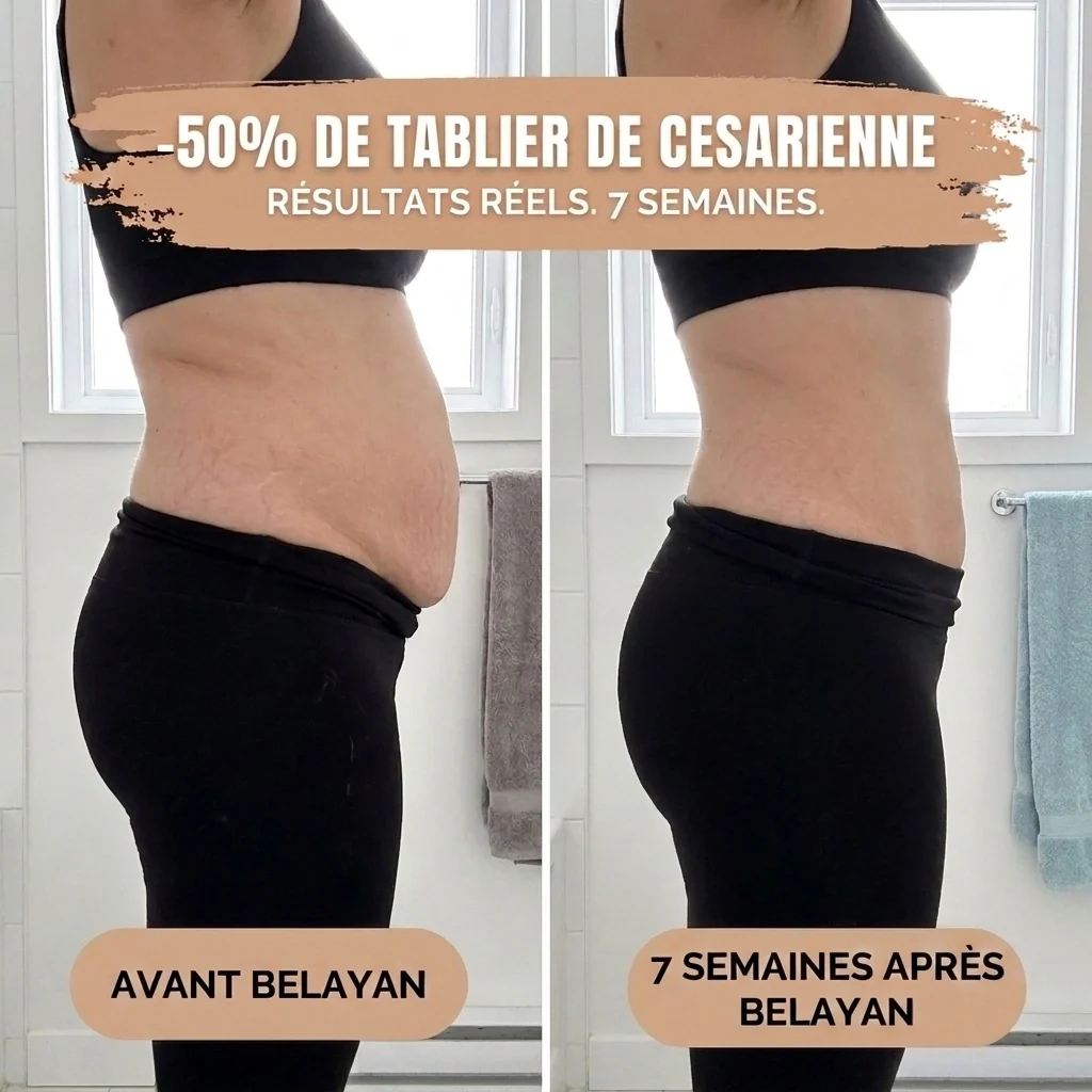 Avant / après 7 semaines : tablier de césarienne réduit de moitié avec Belayan